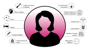 Icons of symptoms of polycystic ovarian syndrome around image of a woman