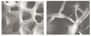 Bone tissue osteoporosis